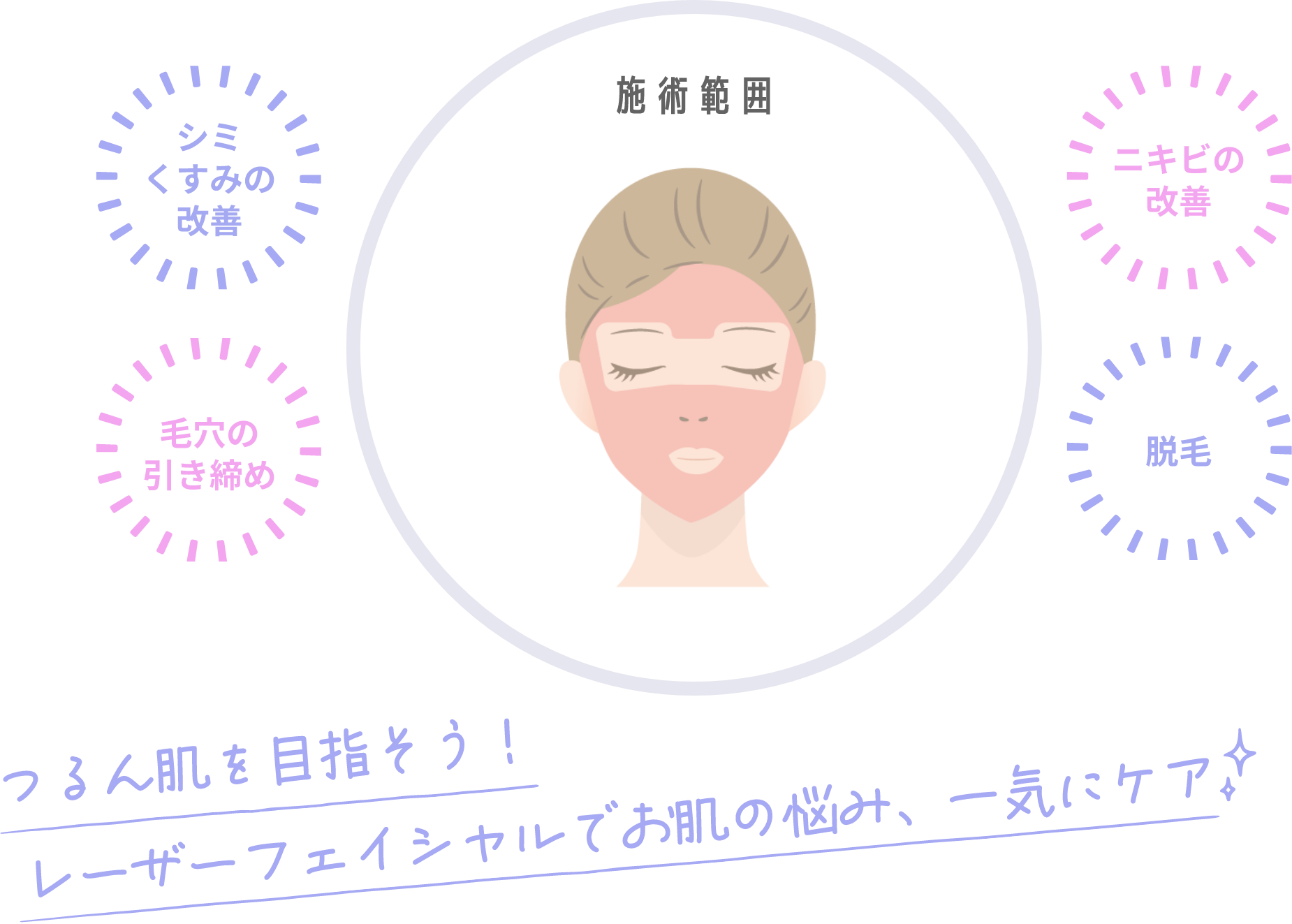 レーザーフェイシャル